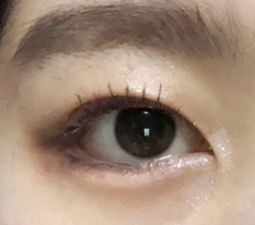 Satisfied with the lateral-lower canthoplasty!