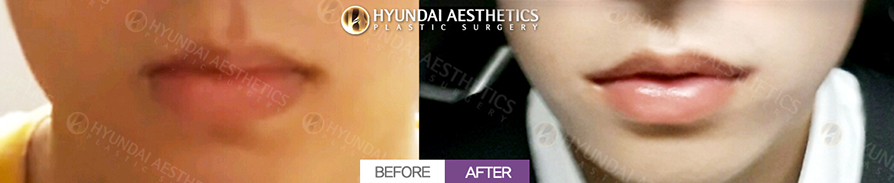 Mouth Corner Lift + Marionette Lines