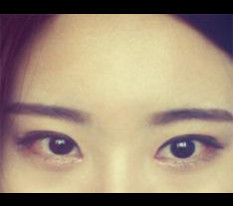 Review of my eye surgery ㅎㅎㅎ