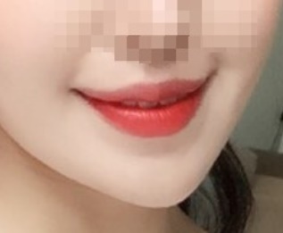 Review of Mouth Corner Surgery!!!!
