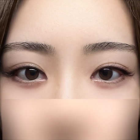 I wanted eyes like Im Bo-ra! (feat. sunken upper eyelids, eye revision surgery)
