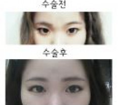 I had buried double eyelids and dual canthoplasty!