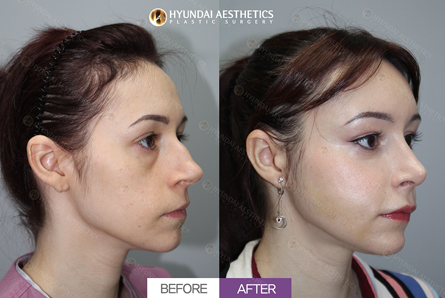 Hump Nose Rhinoplasty + Nasal Tip Surgery