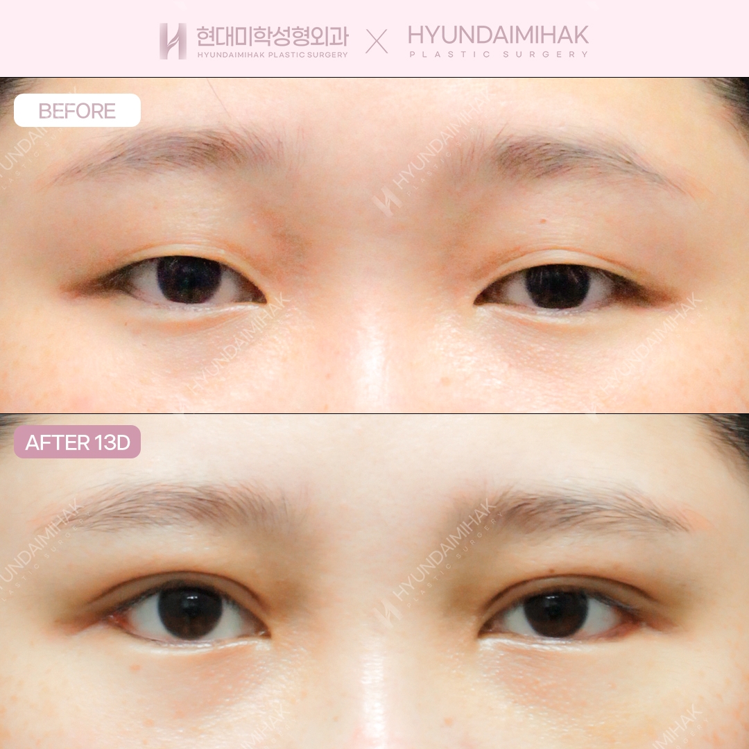 Incisional double eyelid surgery + eye shape correction + dual canthoplasty