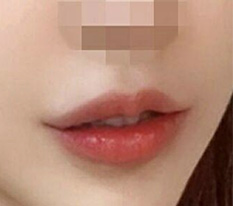 Leaving a review to celebrate my lip corner surgery ㅎ