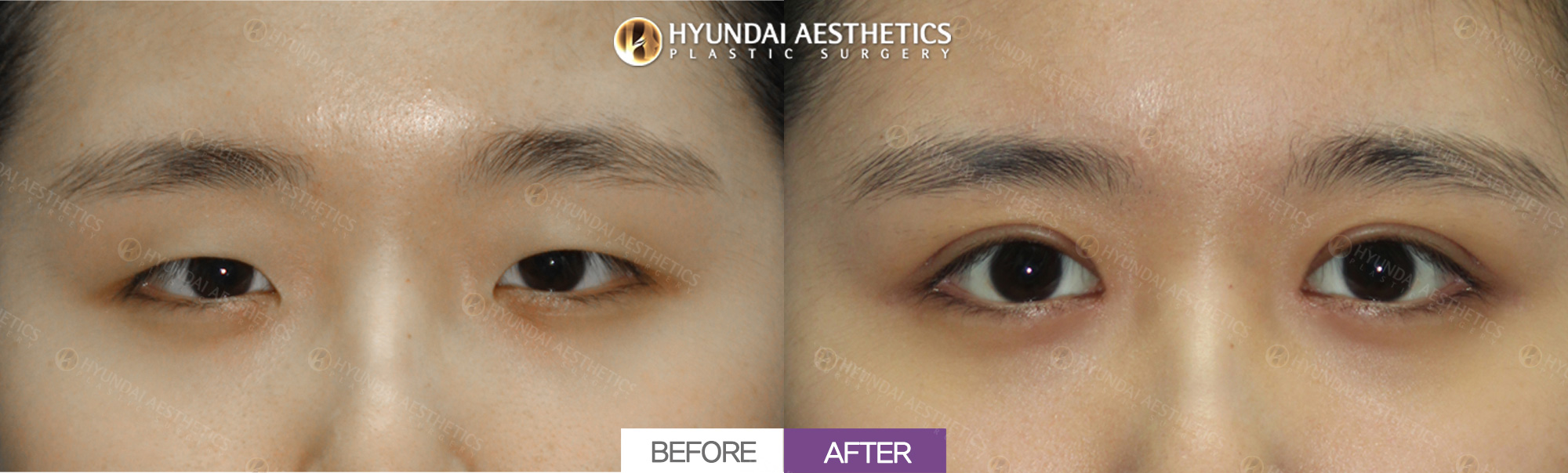 Epicanthoplasty + ptosis correction + double eyelid surgery, 1 month