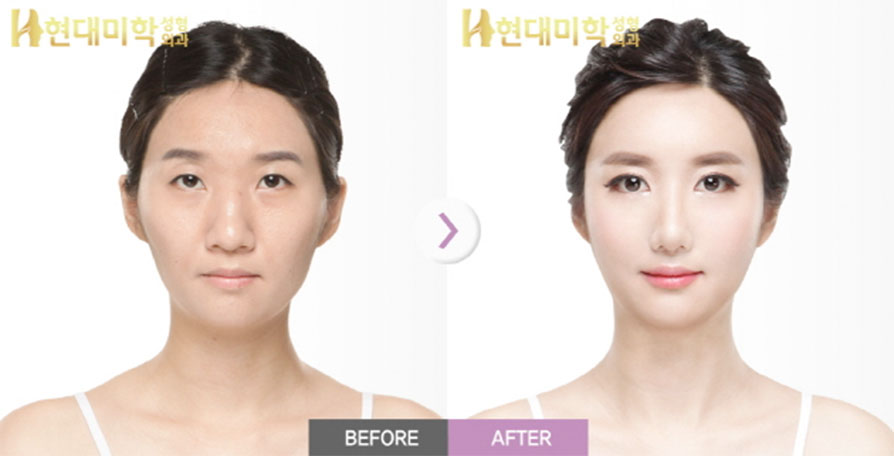 Eyes (Non-Incision), Epicanthoplasty, Lateral Canthoplasty, Lower Canthoplasty, Nose (Osteotomy + Septum + Alar Reduction), Fat Grafting