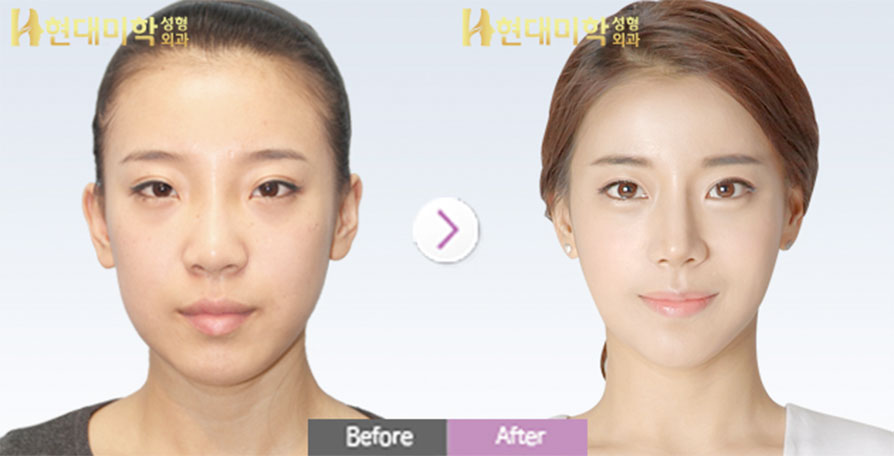 Epicanthoplasty, Rhinoplasty, Septal Cartilage Graft, Silicone, Square Jaw, Fat Grafting