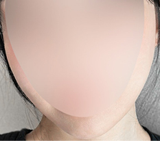 Younger-looking surgery with thread lifting