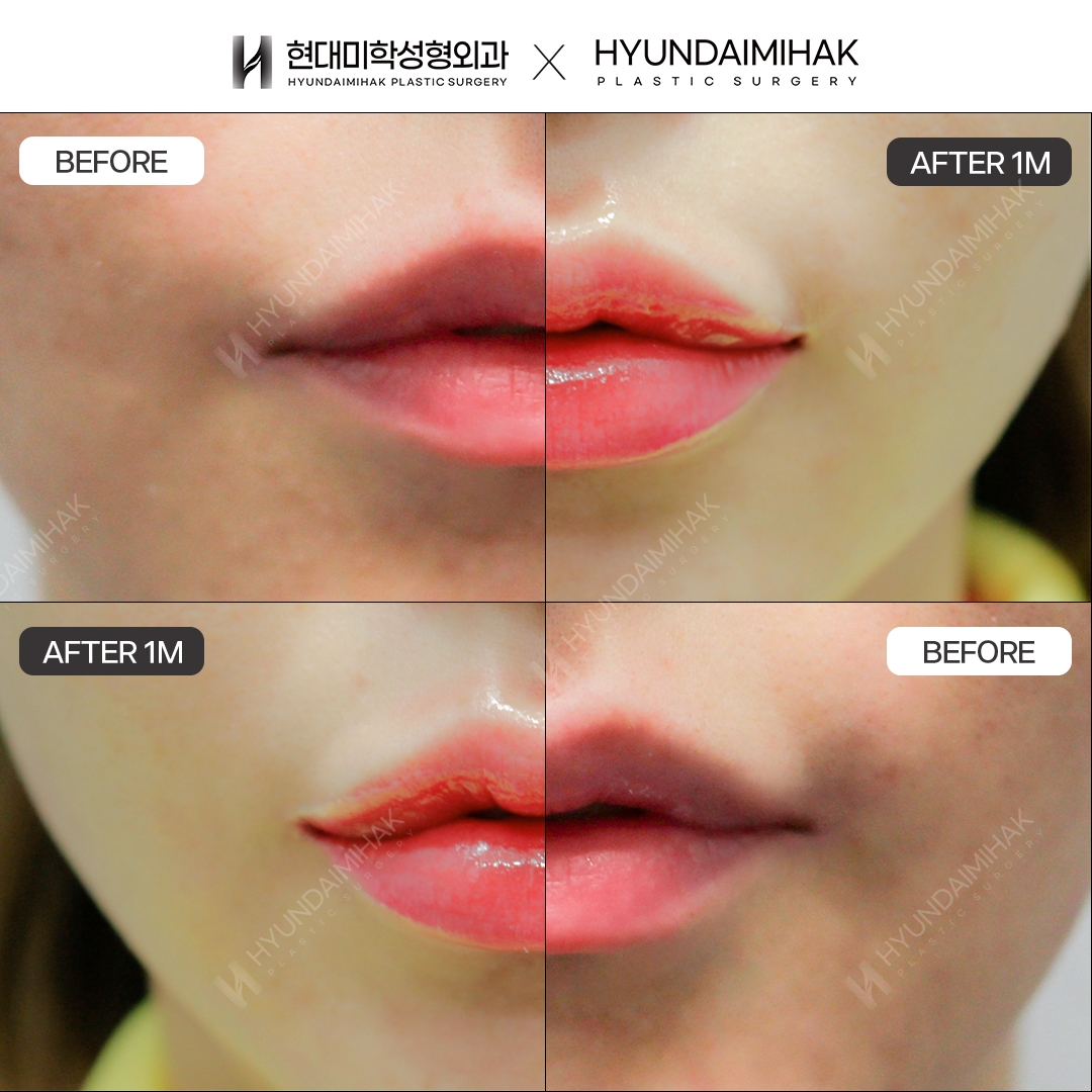 Mouth Corner Surgery and Asymmetry Correction, 1 Month