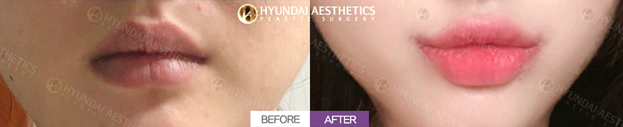 Mouth Corner Lift