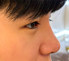 I had eye and nose surgery (male)