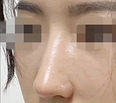 I am back to post my one-month nose surgery review^^