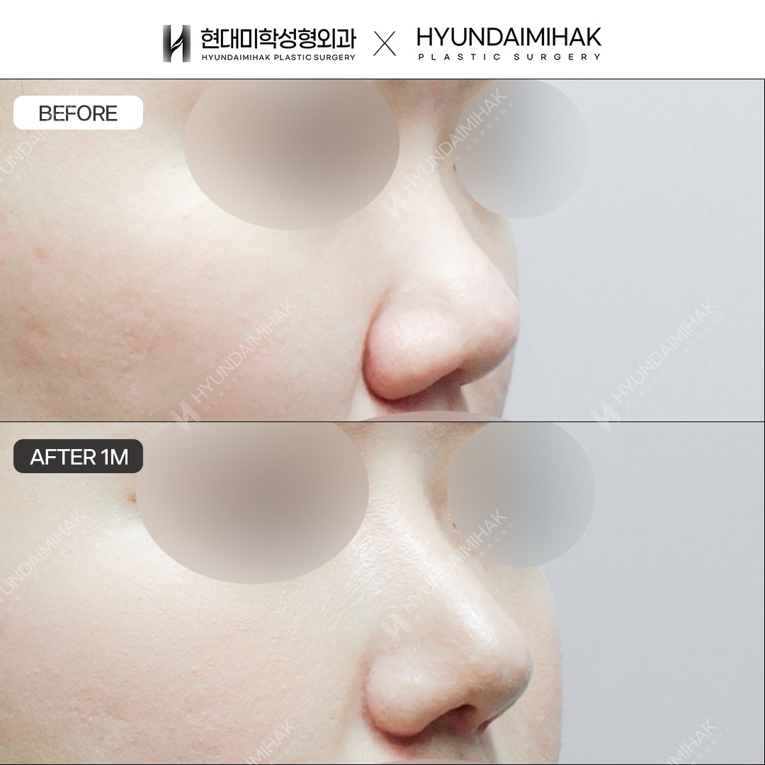[Bulbous nose rhinoplasty] Nasal bridge + nasal tip, 1 month post-op