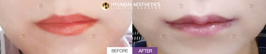 Mouth Corner Lift + Marionette Lines + Cupid's Bow