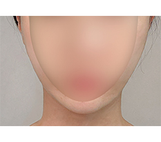Totally Satisfied with the Fat Dissolving Injection> . <