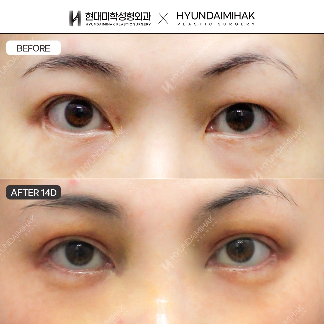[Revision Eye Surgery] Incisional Double Eyelids + Ptosis Correction + Lower Lateral Canthoplasty Restoration