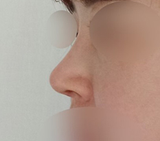 I am so satisfied with my nose surgery~!