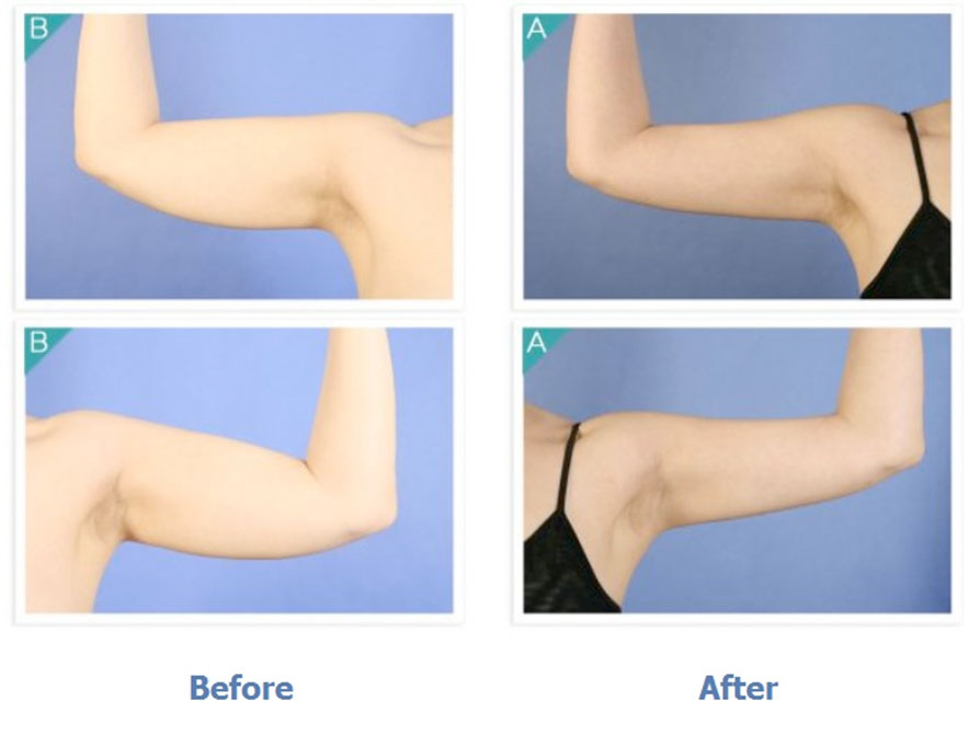 Body Contouring / Arm Liposuction