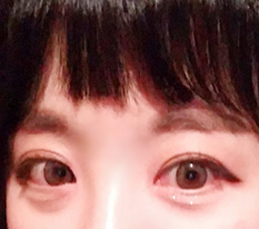 Canthoplasty is totally the best