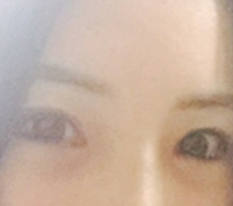 I had revision eye surgery ㅠㅠㅠㅠ