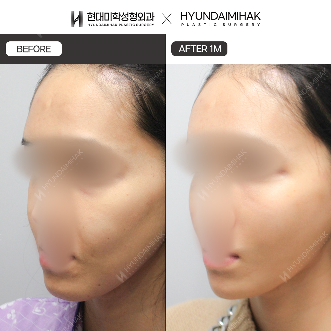 [Anti-Aging Surgery] Thread Lift, 1 Month Post-Op