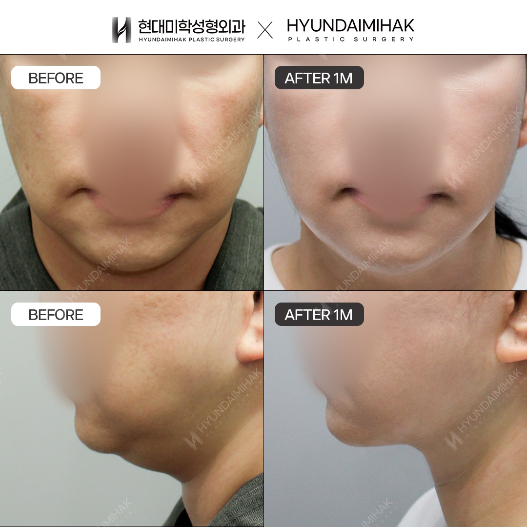 [Facial Rejuvenation] Thread Lift, 1 Month Later