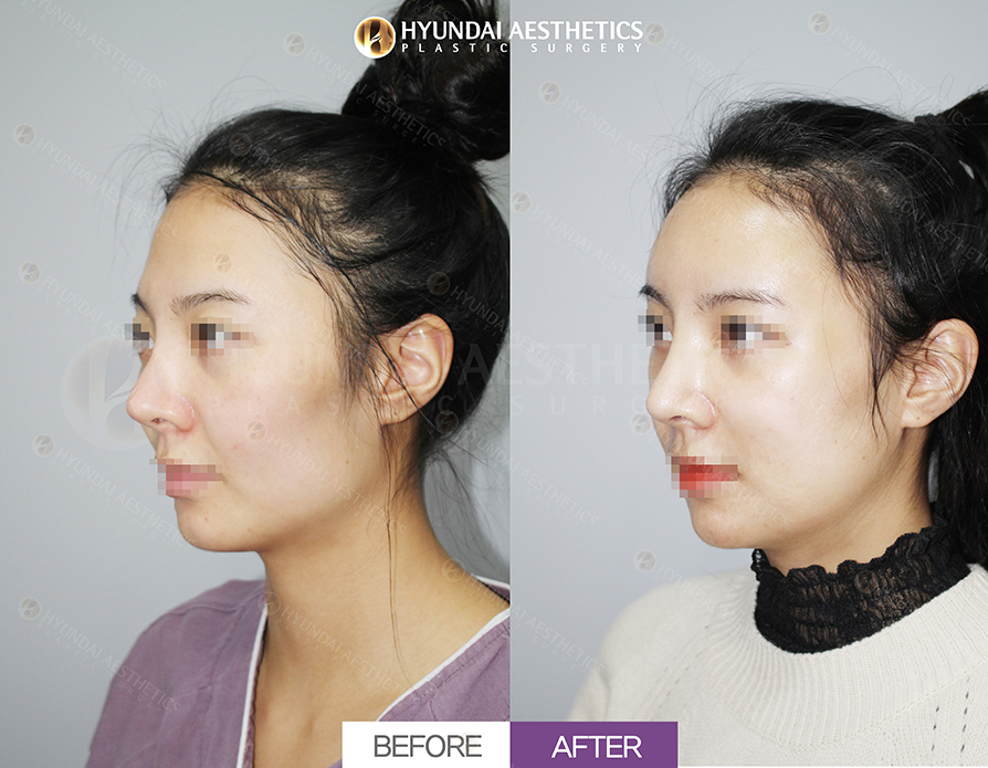Revision Rhinoplasty