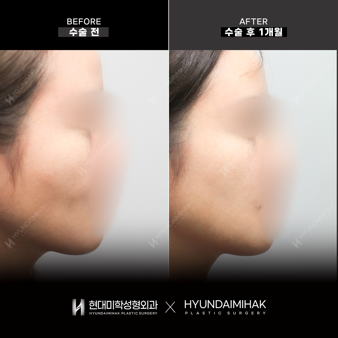 Facial Fat KILL (Contour Injection), 1 Month