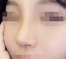 Finally got my nose done after a lot of deliberation ㅎㅎ Total success~