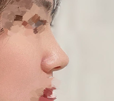 Delicate nose complete
