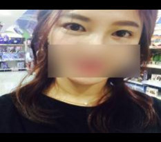 I only had medial, lateral, and lower canthoplasty lol