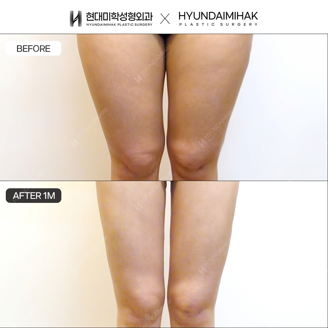 Thigh Liposuction, 1 Month Later