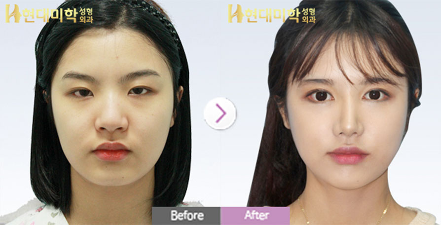 Non-Incision Double-Eyelid Surgery, Epicanthoplasty, Lateral Canthoplasty, Rhinoplasty, Septum, Lateral Osteotomy, Silicone, Nasal Tip, Alar Reduction