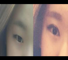 Incisional double eyelids & epicanthoplasty