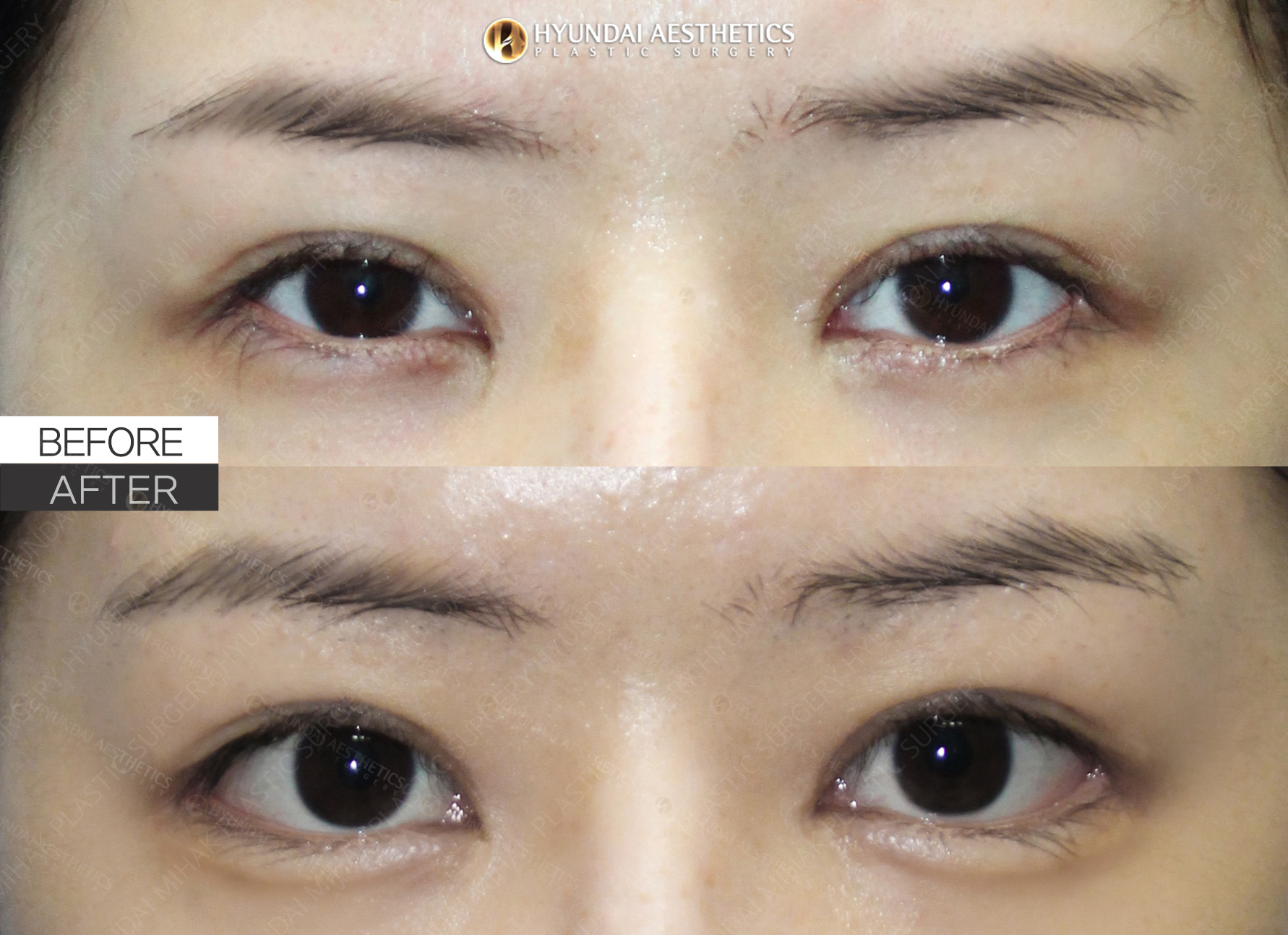 Revision eye surgery (epicanthoplasty reversal, lateral canthoplasty, lower canthoplasty) + ptosis correction, 1 month