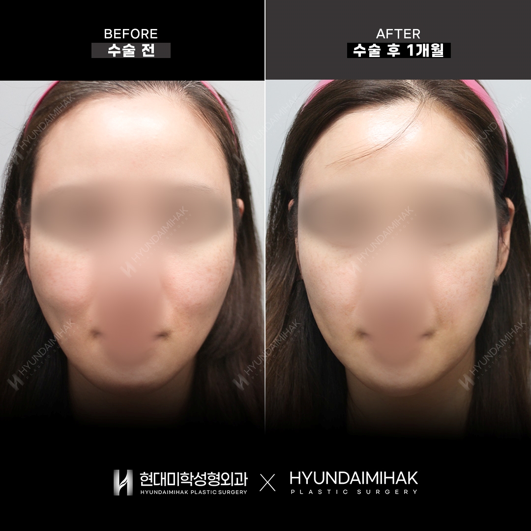 Facial Fat KILL (Contour Injection), 1 Month
