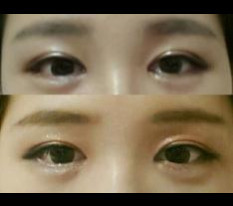 I had incision double-eyelid surgery, medial epicanthoplasty, and dual canthoplasty~~