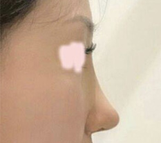 Posting my nose surgery review — what do you think??