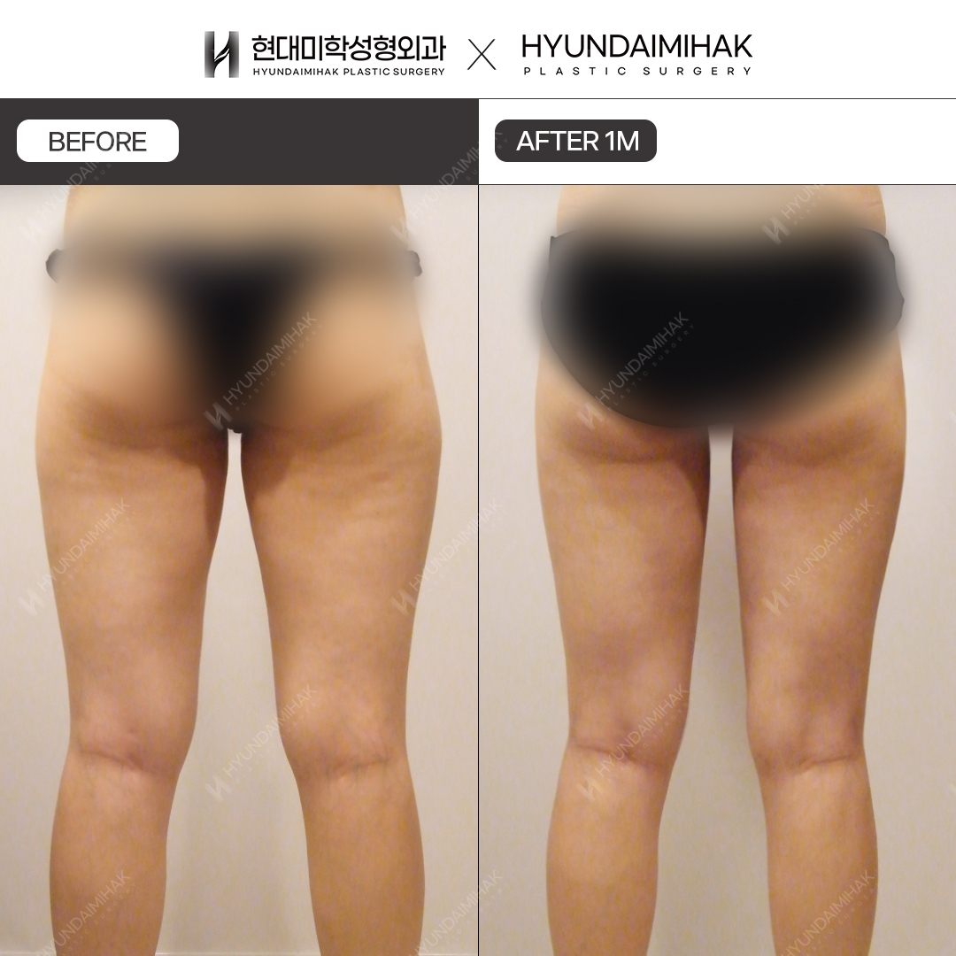 Thigh Liposuction, 1 Month