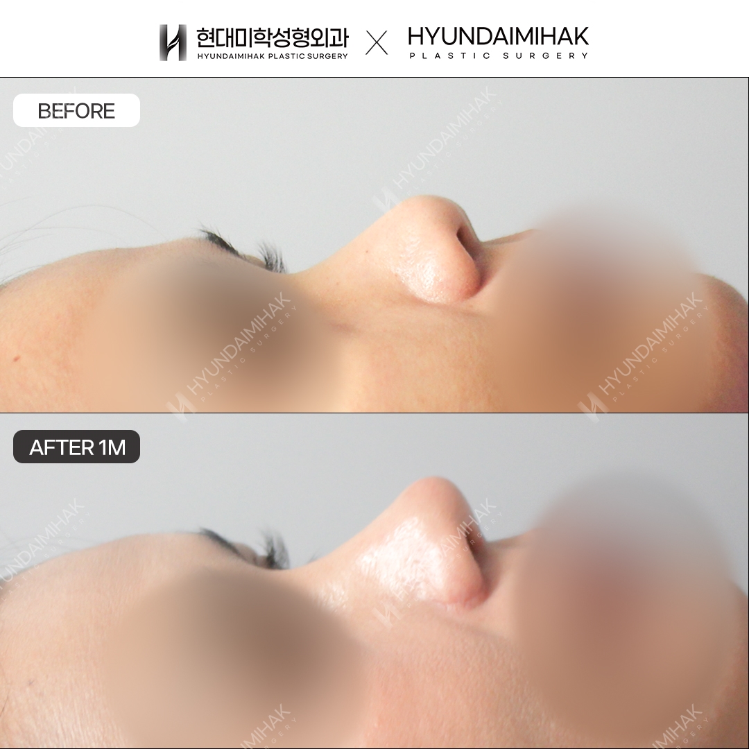 [Bulbous Nose Surgery] Nasal Bridge + Nasal Tip, 1 Month Post-Op