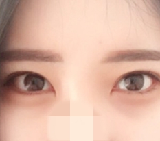 Lateral and lower canthoplasty!
