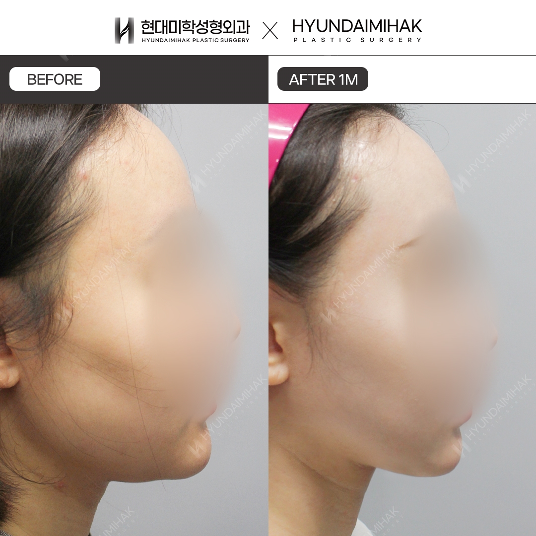 [Lifting] Double-Chin Thread Lift, 1 Month
