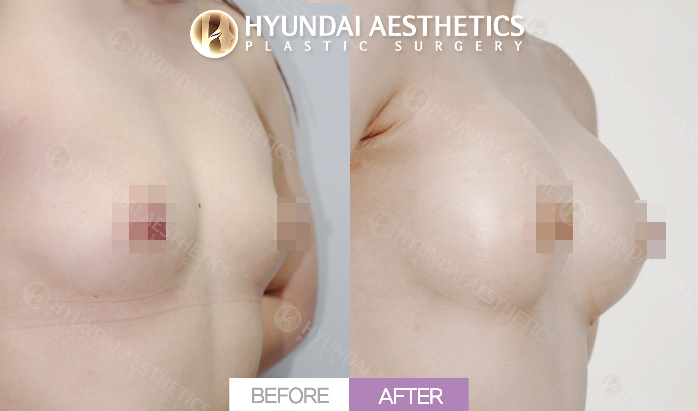 Breast Augmentation (Teardrop Implants)