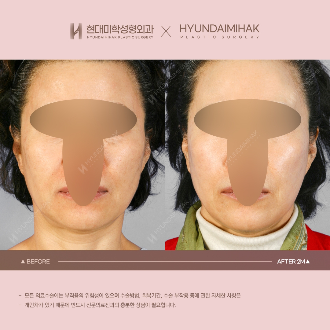 [Facial Rejuvenation] Thread Lift, 2 Months Later