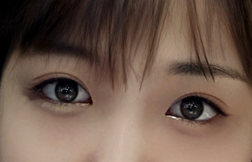 Review of incisional double-eyelid revision + ptosis correction + dual canthoplasty