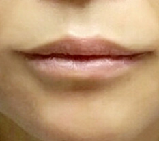 I finally escaped my drooping mouth corners~