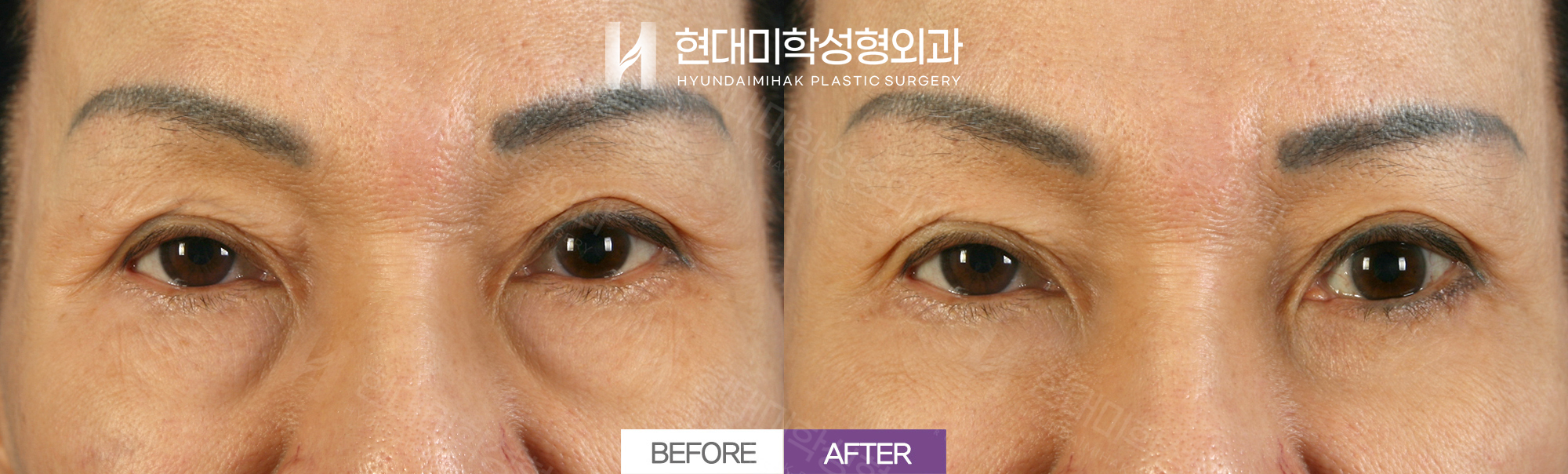 Under-Eye Fat Repositioning