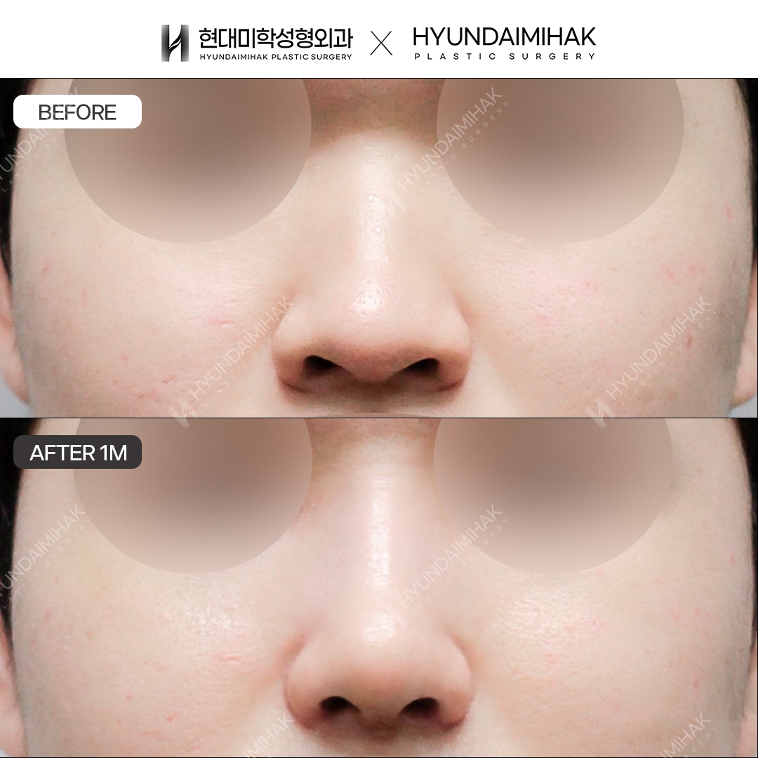 [Male Rhinoplasty] Bridge + Tip, 1 Month