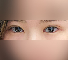 My impression changed with eye surgery